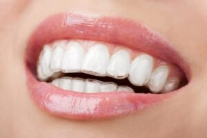 Read more about the article 7 Benefits of Invisalign Clear Aligners | Rainbow Dental Care