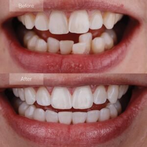 Invisalign clear aligners treatment for a straighter smile